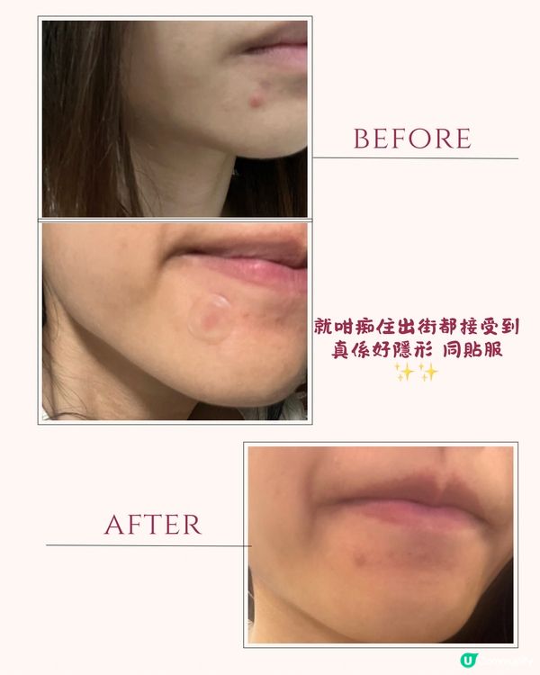 我俾自己粒大毒瘡嚇親😭又紅又腫又痛嘅石頭瘡😤