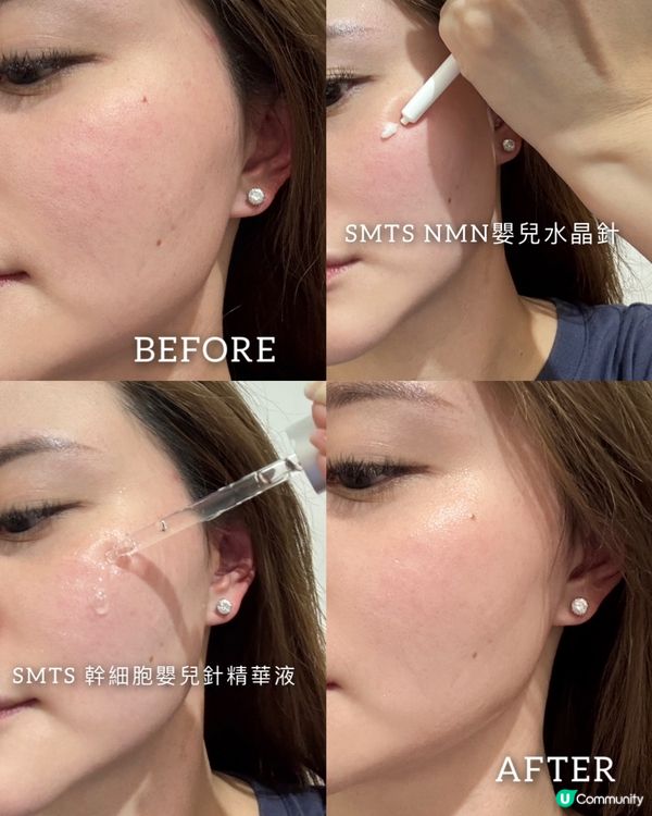 嬰兒針升級版！🤩 體驗分享！