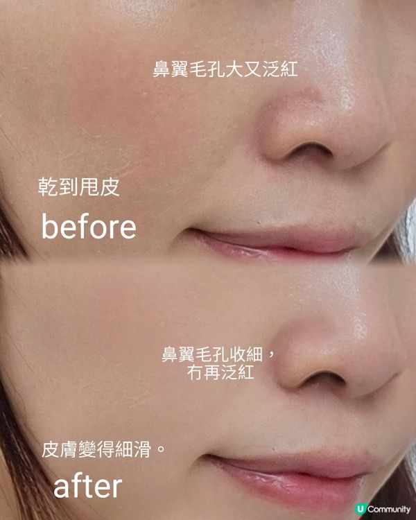 曬後急救神器！光療膜儀拯救曬傷肌 🏖️✨