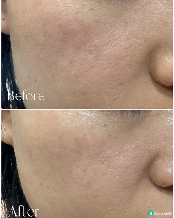 用煥膚MTS收毛孔美容儀堅有效啊！