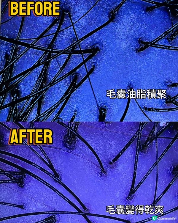 【妍髮活髮專家 | 毛囊淨化&激光活髮療程】