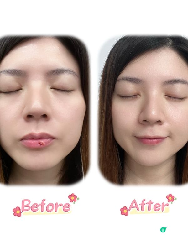 尚護健唇瘡啫喱