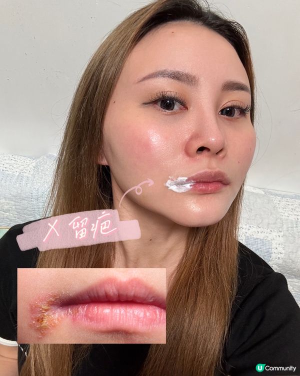 爛嘴仔救星！唇瘡走開👋🏻！搽完即刻唔痛！🤩