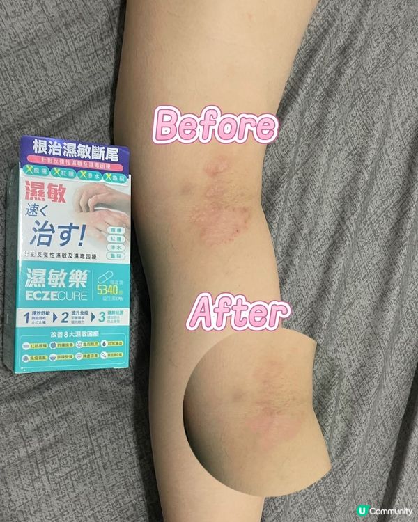 濕疹救星！擺脫痕癢煩惱 🥳 #濕敏樂 #萬寧