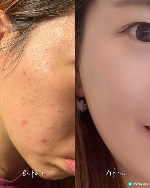 袪痘淡印收毛孔按摩筆