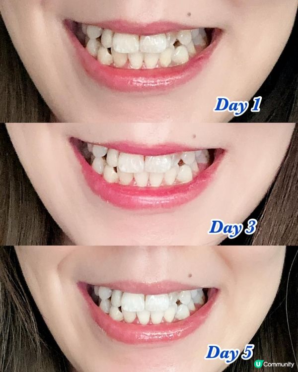 反應熱烈 ♥ 再來一日限定優惠！►New Smile藍光美白牙齒機