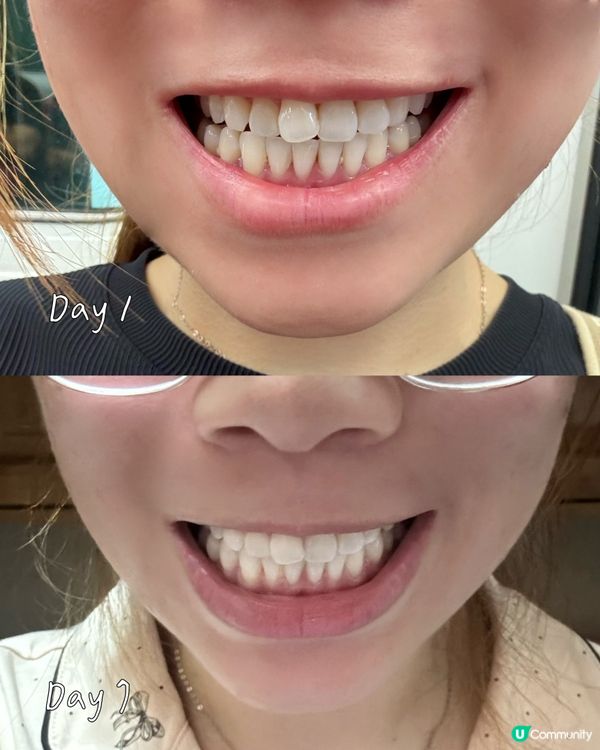 😬New Smile藍光美白牙齒機團購💝
