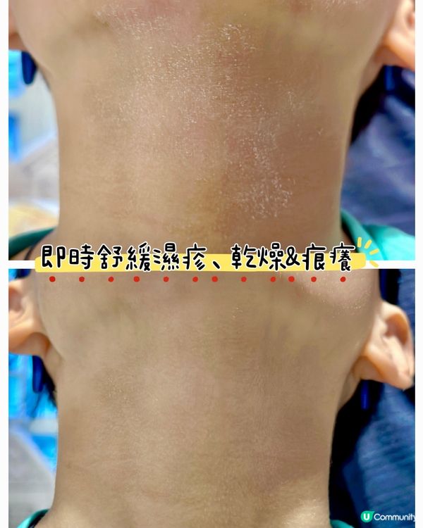濕疹關注月 - 🫶🏻 Cetaphil舒特膚為你打打氣