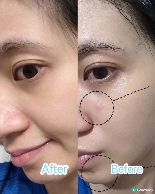 暗瘡印凹凸洞神器❗️❗️