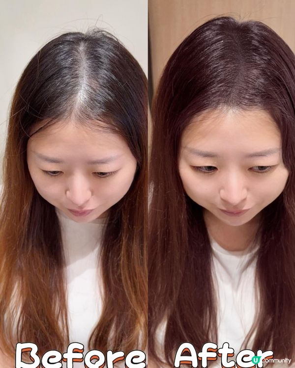 【真人實測】髮際線救星！3個月毛髮重生🤩