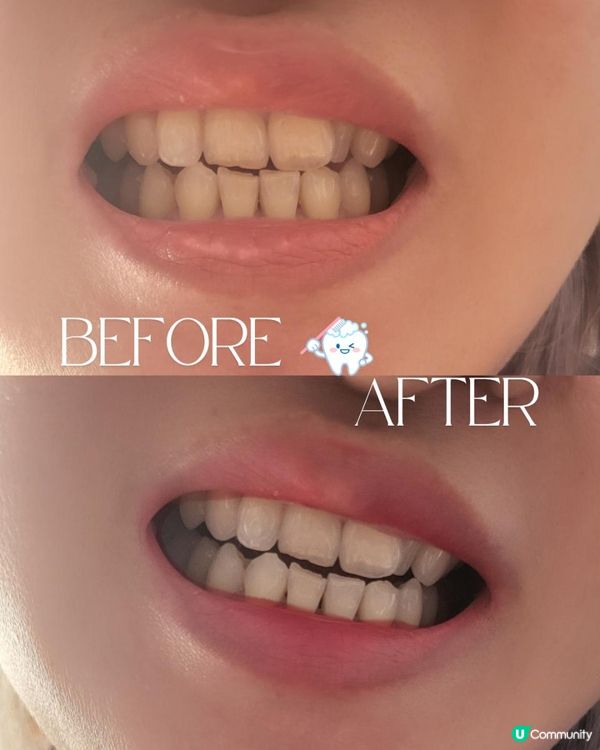 ✨ 牙齒都要做facial