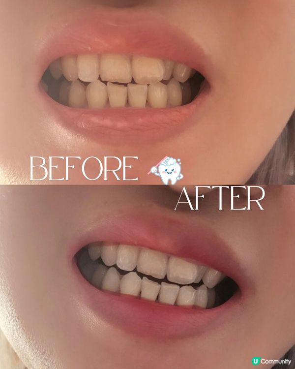 ✨ 牙齒都要做facial