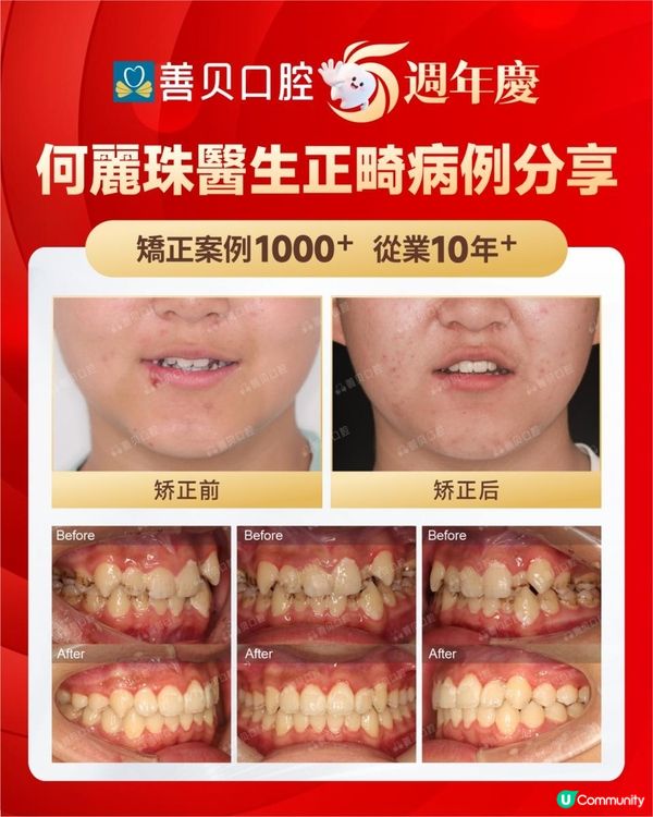 善貝口腔箍牙好唔好？真實個案分享，14個月排齊牙齒