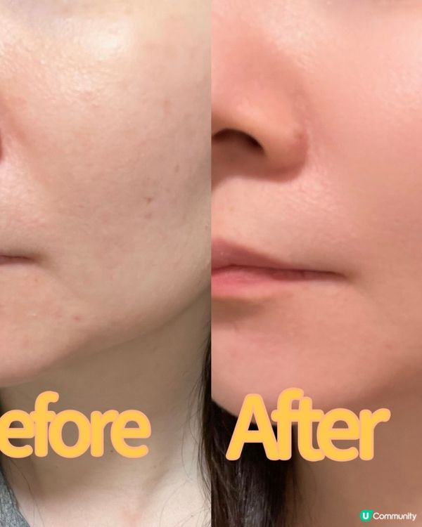 告別痘痘肌！🇰🇷水凝霜拯救你！