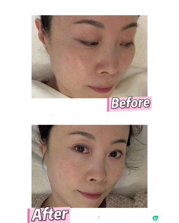 西班牙皇牌醫學煥膚療程