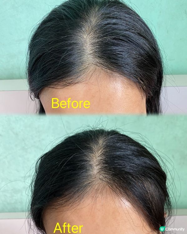 脫髮救星，光療帽幫你生髮！😎