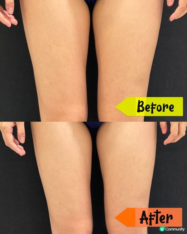 【NEODERM｜年輕塑形內外排脂組合】