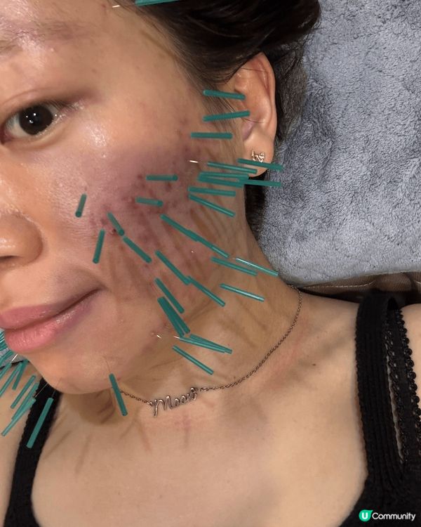 最近生咗好多荷爾蒙瘡，去中醫調理一下，中醫師針對痘痘施美顏針...