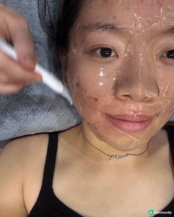 最近生咗好多荷爾蒙瘡，去中醫調理一下，中醫師針對痘痘施美顏針...