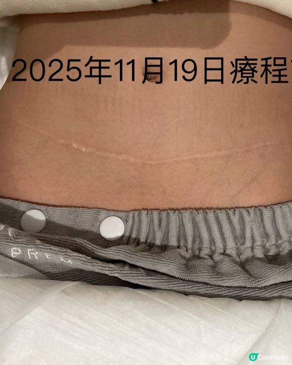 疤痕救星！淡化疤痕初體驗🤩 效果超驚喜！