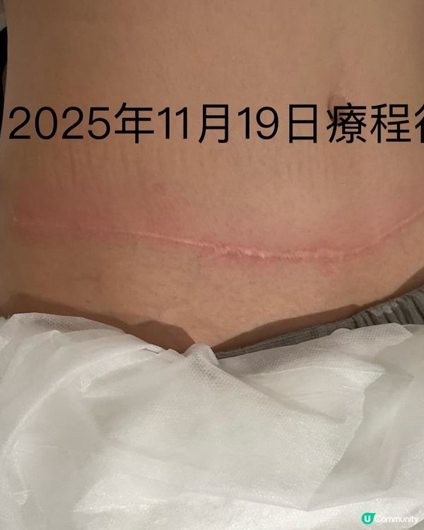 疤痕救星！淡化疤痕初體驗🤩 效果超驚喜！