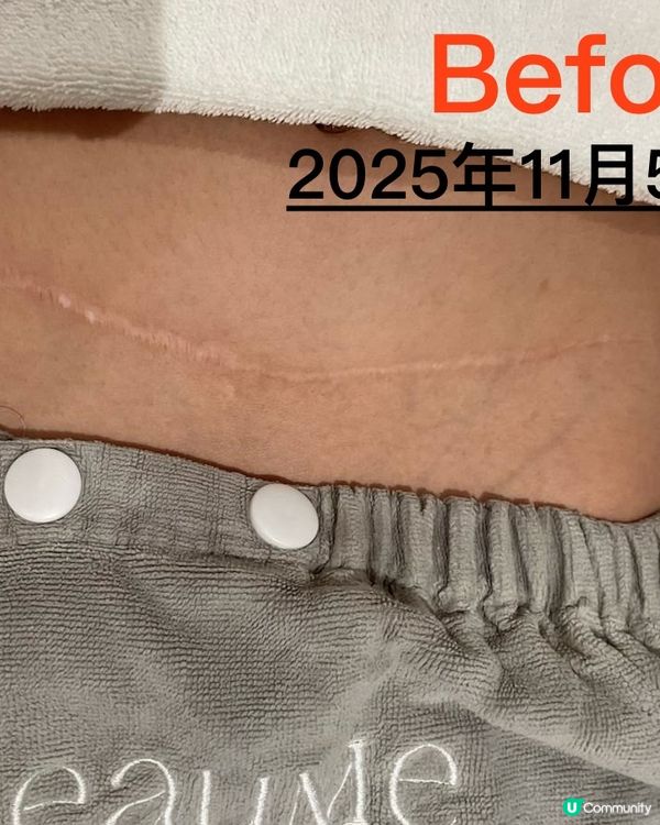 疤痕救星！淡化疤痕初體驗🤩 效果超驚喜！