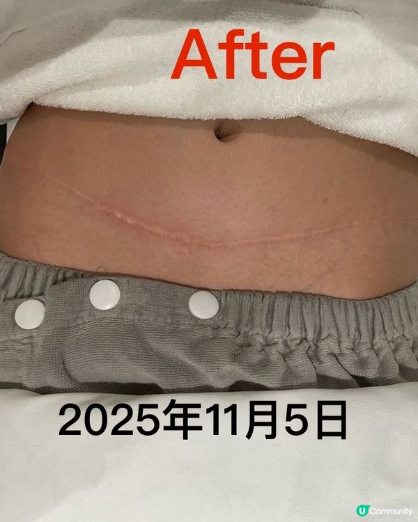 疤痕救星！淡化疤痕初體驗🤩 效果超驚喜！