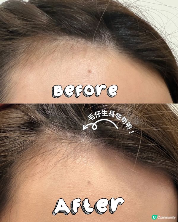 想額頭生毛毛？必試呢支精華！🤩