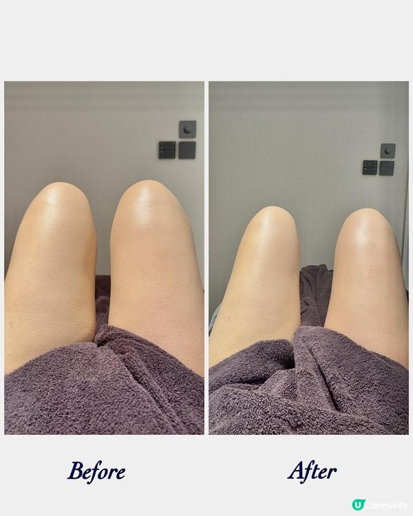 ✨Minca Beaute x 智能標靶式溶脂 + 瓷溫消腫塑形療程🦵