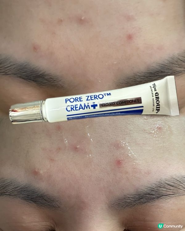 暗瘡爆發💔！救星係呢兩支！三酸溶解黑頭暗粒膏