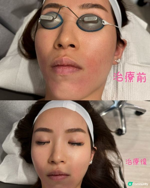 15分鐘變靚靚！✨ 激光療程初體驗！🤩 告別瑕疵！👋