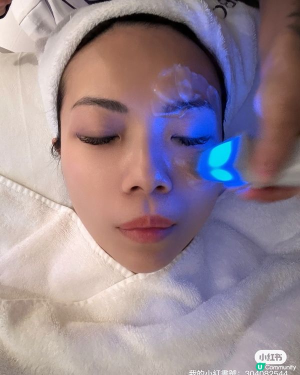 深夜剪片黨必睇！眼袋ByeBye👋🏻！眼袋槍療程勁w