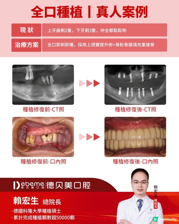 深圳牙醫好介紹👍🏻德貝美種牙🦷賴院長勁專業💯