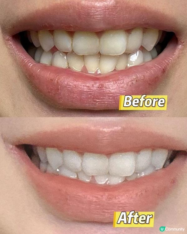 美白牙貼一貼就白😍
