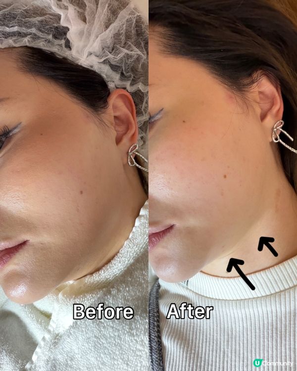 塊臉Firm咗！😍 4代鋼筋索效果驚人！