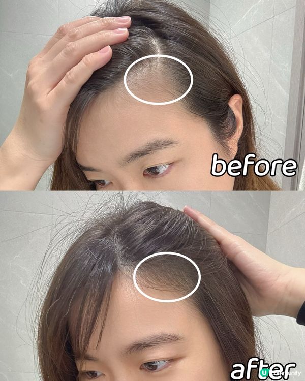 頭髮救星—韓國bananal🌟【頭皮微針精華】🌟