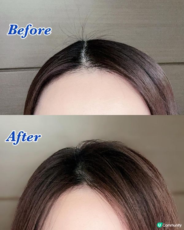 韓國熱賣 ♥ 防脫神器！►BANANAL頭皮微針精華