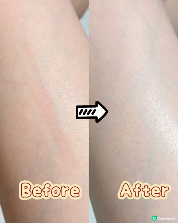 娥羅納英軟膏：70年安心之選！💯