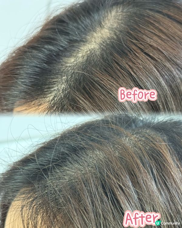 【生髮法寶✨】脫髮救星！10分鐘養出濃密秀髮！🤩