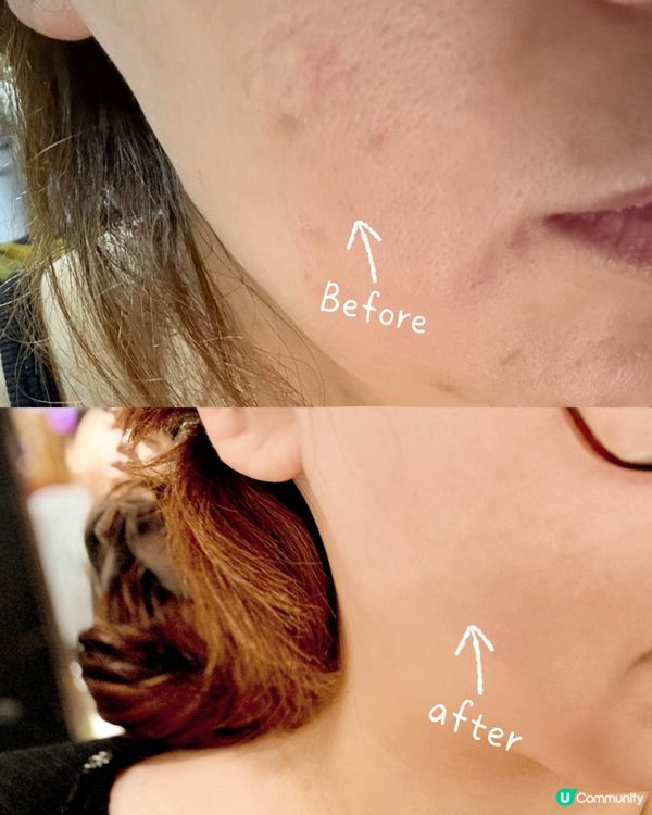 暗瘡印掰掰👋🏻 煥白勁有效！🤩