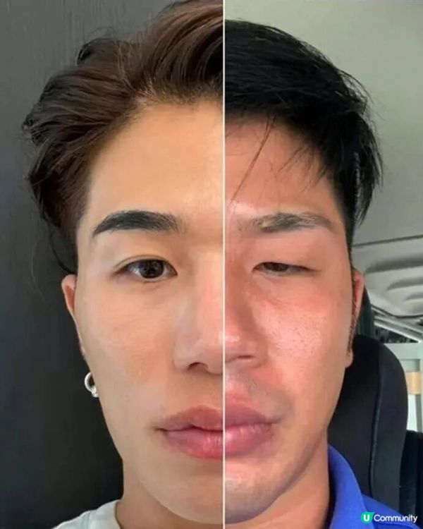 33歲日本男曾被笑似「猩猩」🦍整容後靚仔到似明星😱豪砸百萬円後出街都會被搭訕⁉️