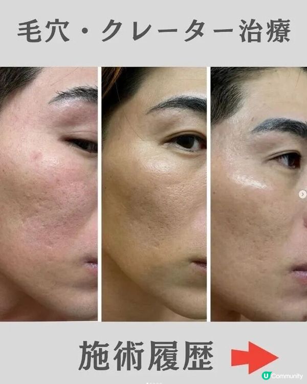 33歲日本男曾被笑似「猩猩」🦍整容後靚仔到似明星😱豪砸百萬円後出街都會被搭訕⁉️