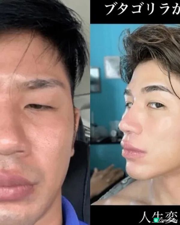 33歲日本男曾被笑似「猩猩」🦍整容後靚仔到似明星😱豪砸百萬円後出街都會被搭訕⁉️