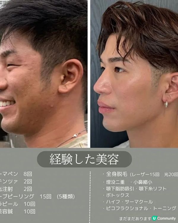 33歲日本男曾被笑似「猩猩」🦍整容後靚仔到似明星😱豪砸百萬円後出街都會被搭訕⁉️