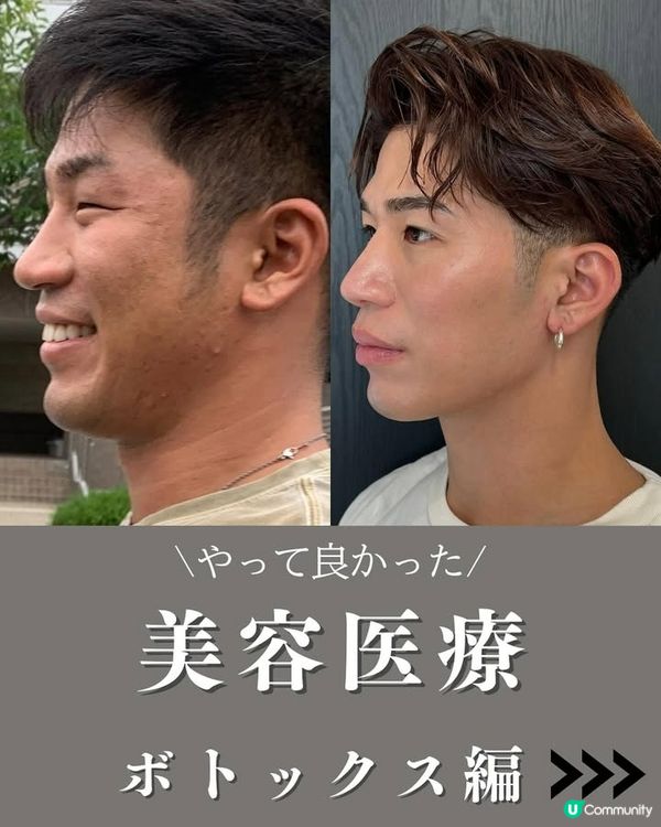 33歲日本男曾被笑似「猩猩」🦍整容後靚仔到似明星😱豪砸百萬円後出街都會被搭訕⁉️