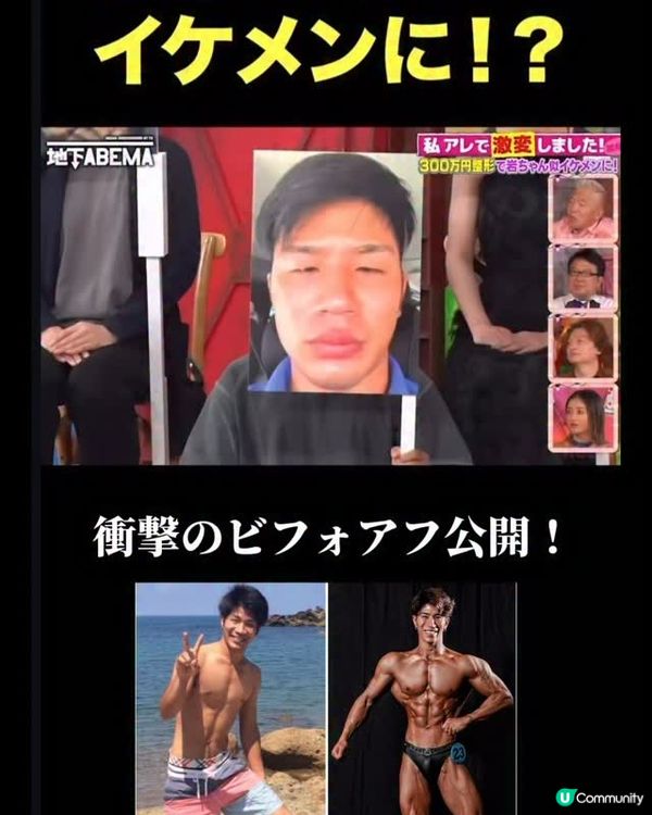 33歲日本男曾被笑似「猩猩」🦍整容後靚仔到似明星😱豪砸百萬円後出街都會被搭訕⁉️