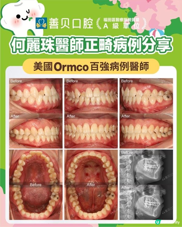 【深圳箍牙日記】成年人倒及牙｜不剝牙矯正｜快至13個月結束｜金屬自鎖矯治反頜 | 深圳善貝口腔 | 正畸科何麗珠主任