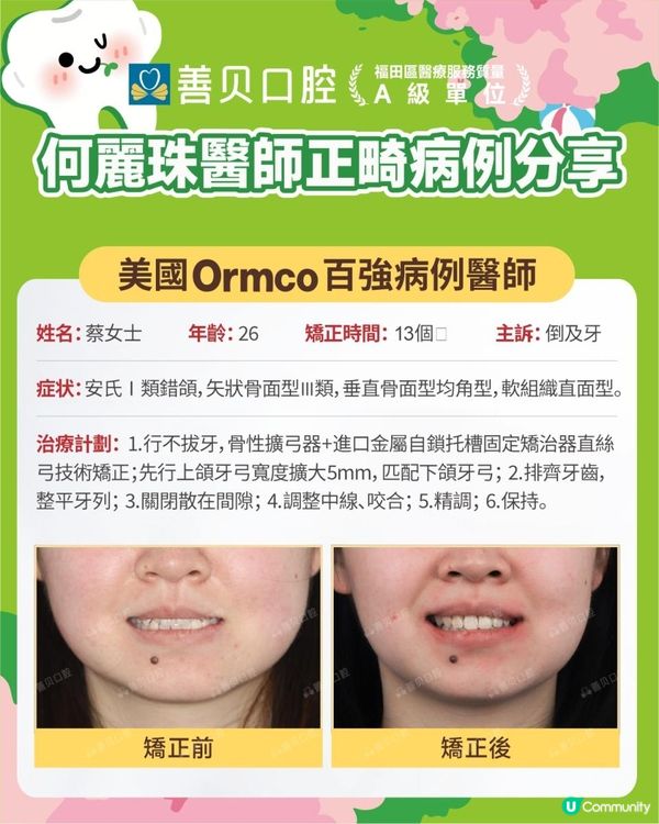 【深圳箍牙日記】成年人倒及牙｜不剝牙矯正｜快至13個月結束｜金屬自鎖矯治反頜 | 深圳善貝口腔 | 正畸科何麗珠主任
