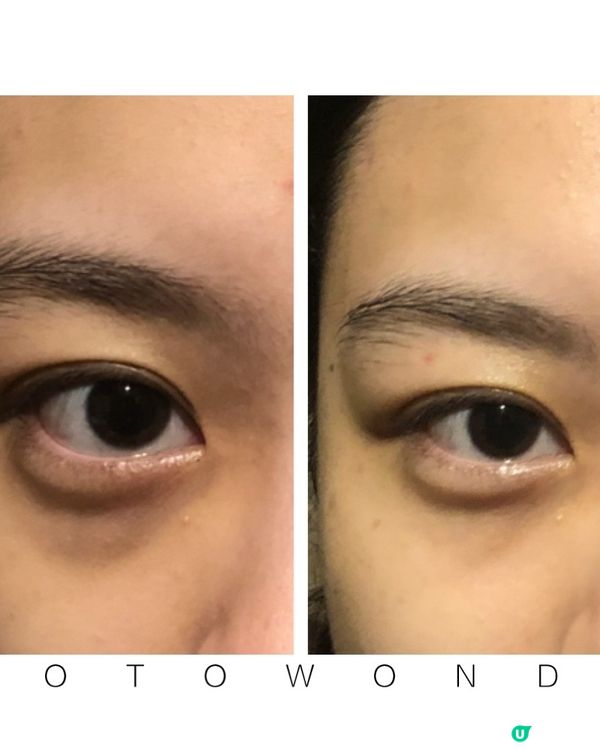 為什麼愈來愈多人選擇 Eye Glow 改善黑眼圈淚溝？ 