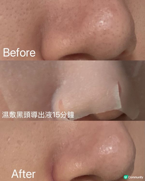 👃韓國去黑頭神器❓❗️